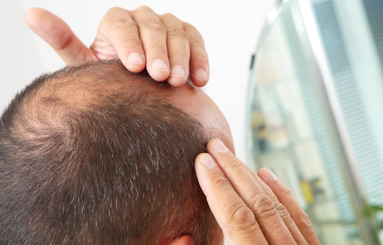 צמיחה מחודשת של שיער: תרופות סבתא לזירוז והצמחת שיער מהירה צמיחה מחודשת של שיער: תרופות סבתא לזירוז והצמחת שיער מהירה