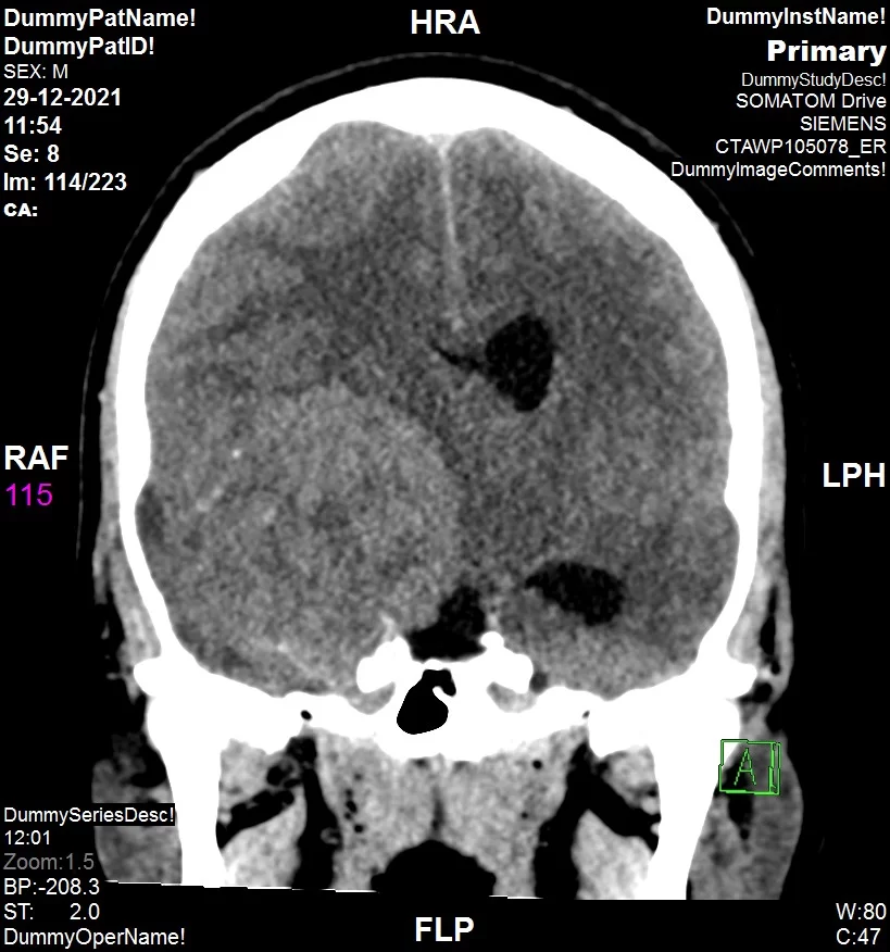 חרדי שהתלונן על מיגרנה קשה נמצא עם גידול בגודל אשכולית     