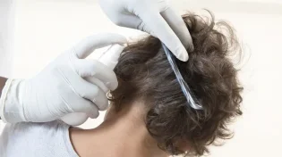 שוב מכת כינים: האם מותר להרוג כינים בשבת?
