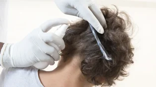 שוב מכת כינים: האם מותר להרוג כינים בשבת?