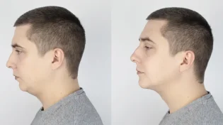 מתמודדים עם פנים מלאות? סנטר כפול? יש פתרון