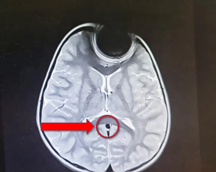 נגמר בנס: סוללה התגלתה באפה של הפעוטה שהתלוננה על כאבים