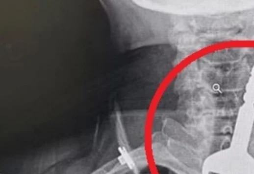 סעודיה: גבר אושפז עם קשיי נשימה. זה מה שמצאו הרופאים בגרונו 