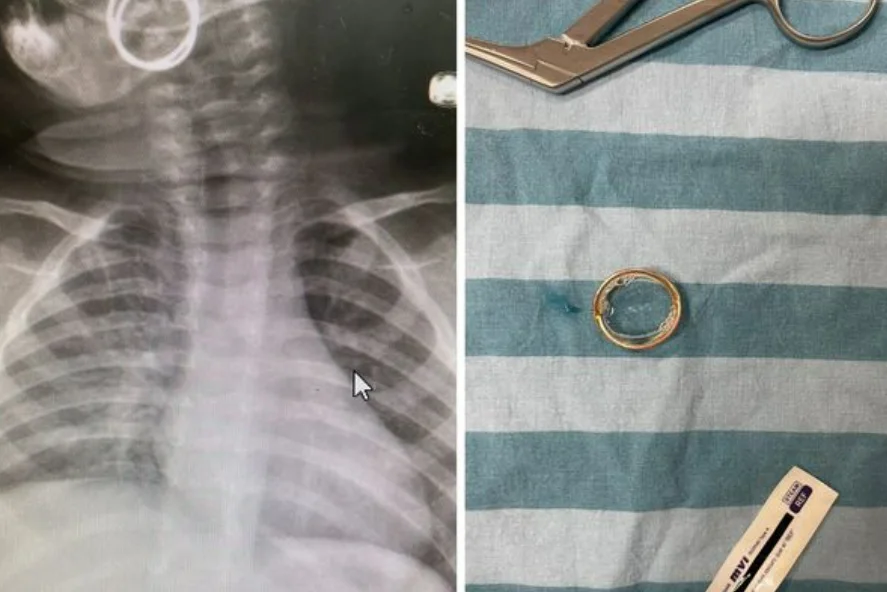 בן תשעה חודשים הובהל לבית החולים סורוקה: זה מה שנמצא בגופו 