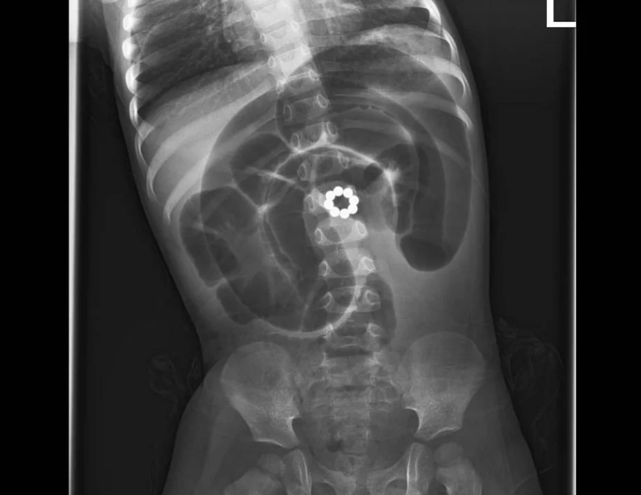 מגנטים שנמצאו בגופו של הפעוט מגנטים שנמצאו בגופו של הפעוט