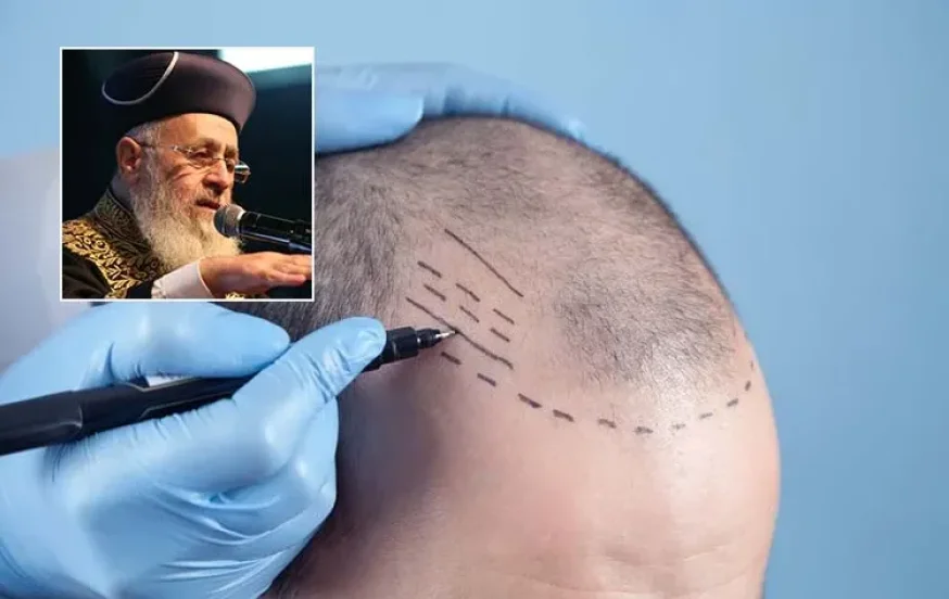 מי שעשה השתלת שיער, מניח תפילין? מי שעשה השתלת שיער, מניח תפילין?