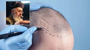 מי שעשה השתלת שיער, מניח תפילין?