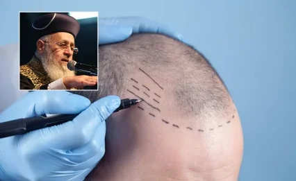 מי שעשה השתלת שיער, מניח תפילין?