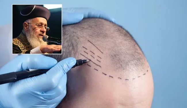מי שעשה השתלת שיער, מניח תפילין?