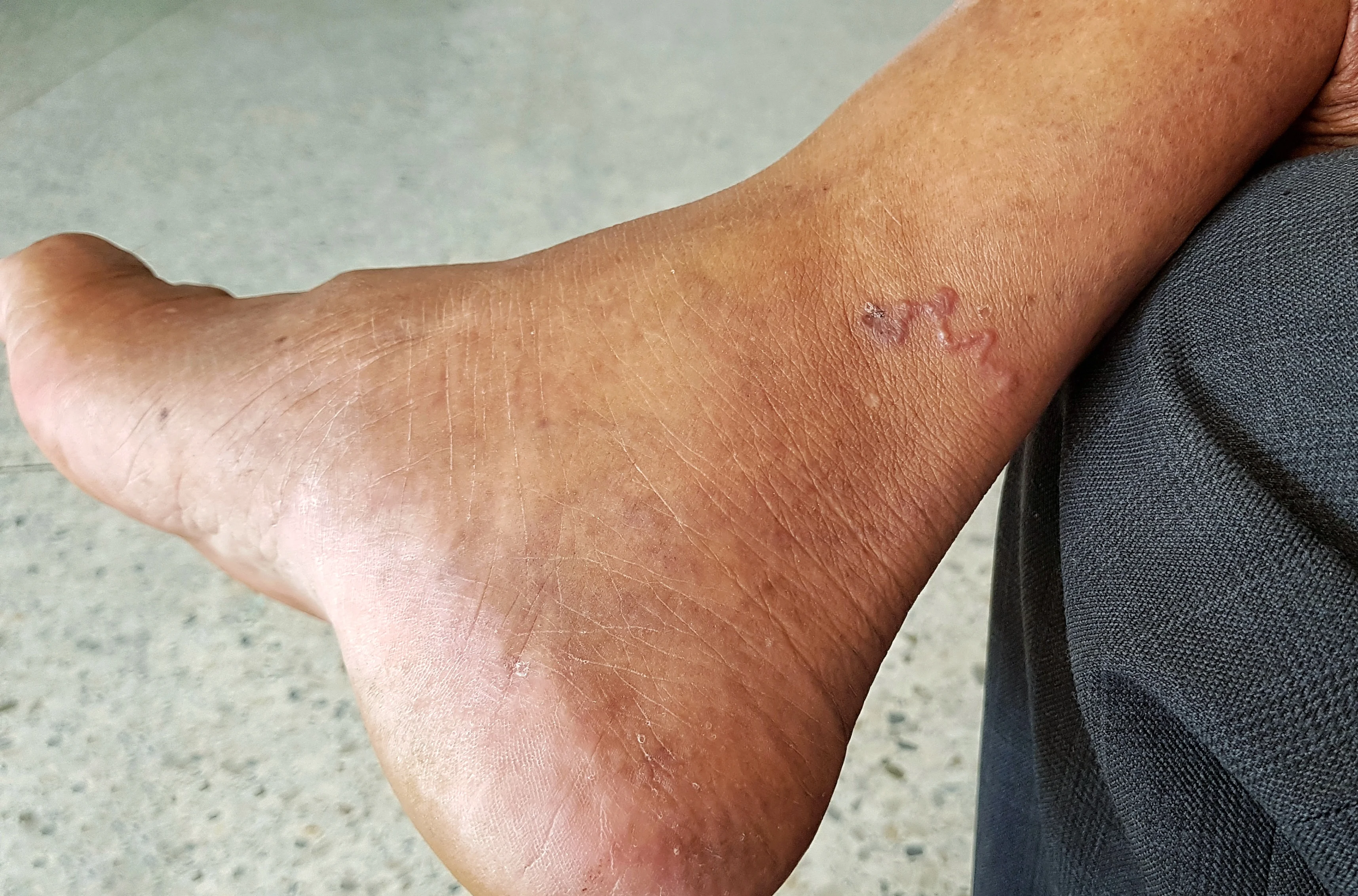 תולעת החודרת מתחת לעור