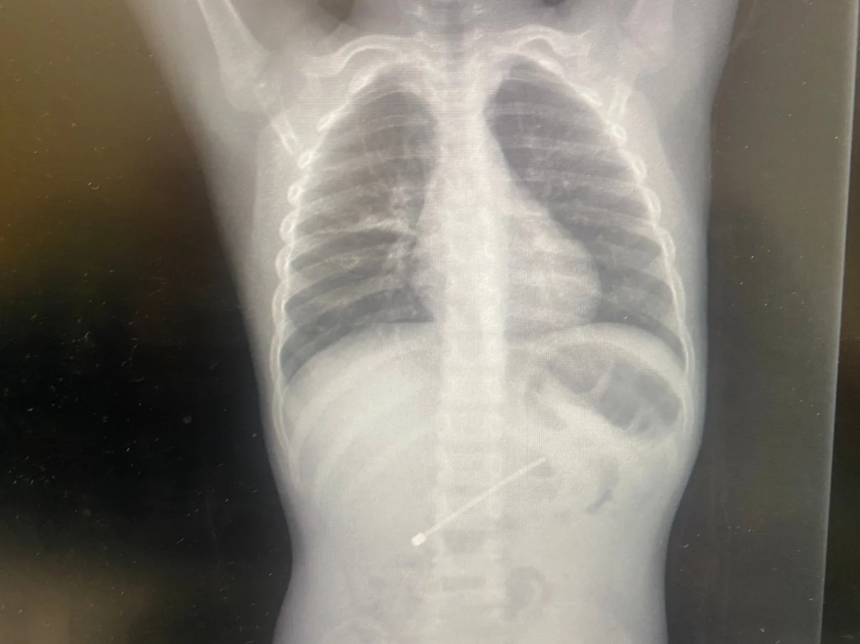 בליעת גוף זר