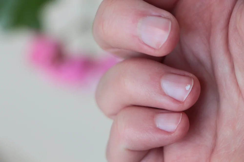 כתמים לבנים בציפורניים: לא מה שחשבתם כתמים לבנים בציפורניים: לא מה שחשבתם