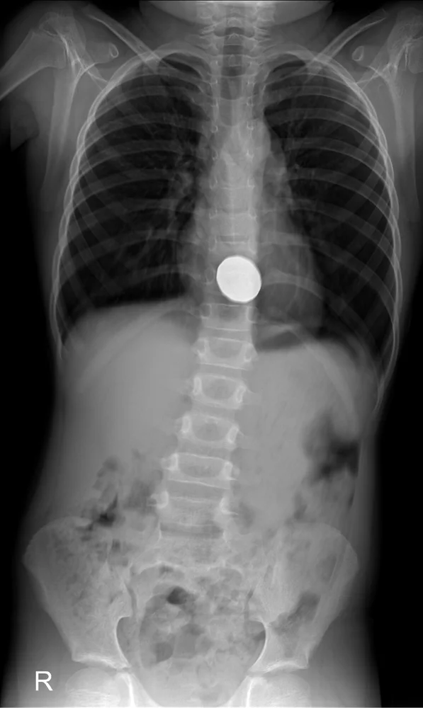 עצמים שנמצאו בקיבה של ילדים 