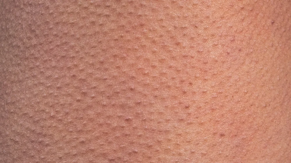 האם 'עור ברווז' זה מסוכן? אתם חייבים לקרוא את זה 