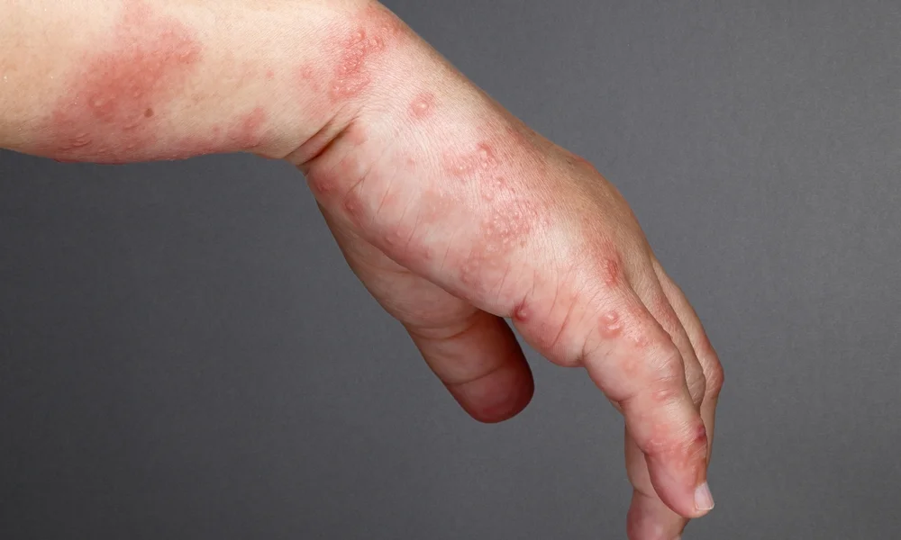 שלבקת חוגרת: כך תזהו בזמן, וכך תמנעו אותה