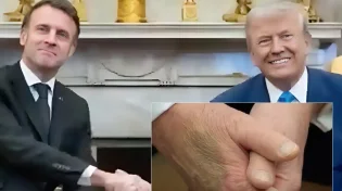 חשש בריאותי לנשיא טראמפ: כתמים מסתוריים על ידו מעוררים תהיות