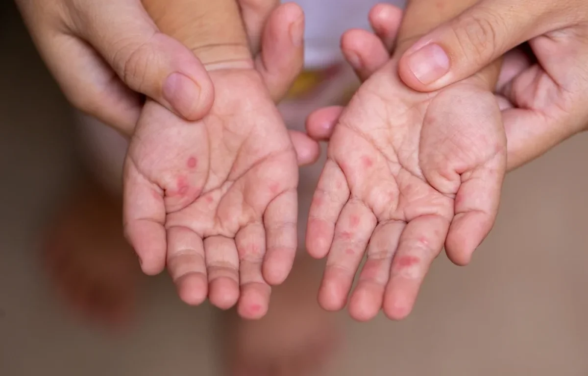 חולה חצבת חזר מלונדון ונכח במקומות ציבוריים &ndash; משרד הבריאות מפרסם אזהרה