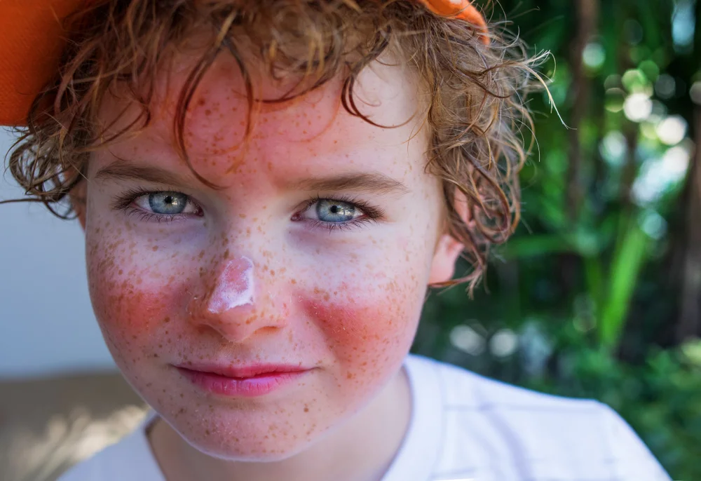 העור שלנו תחת התקפה: מה שמש עושה לו, ואיך אפשר לשמור עליו