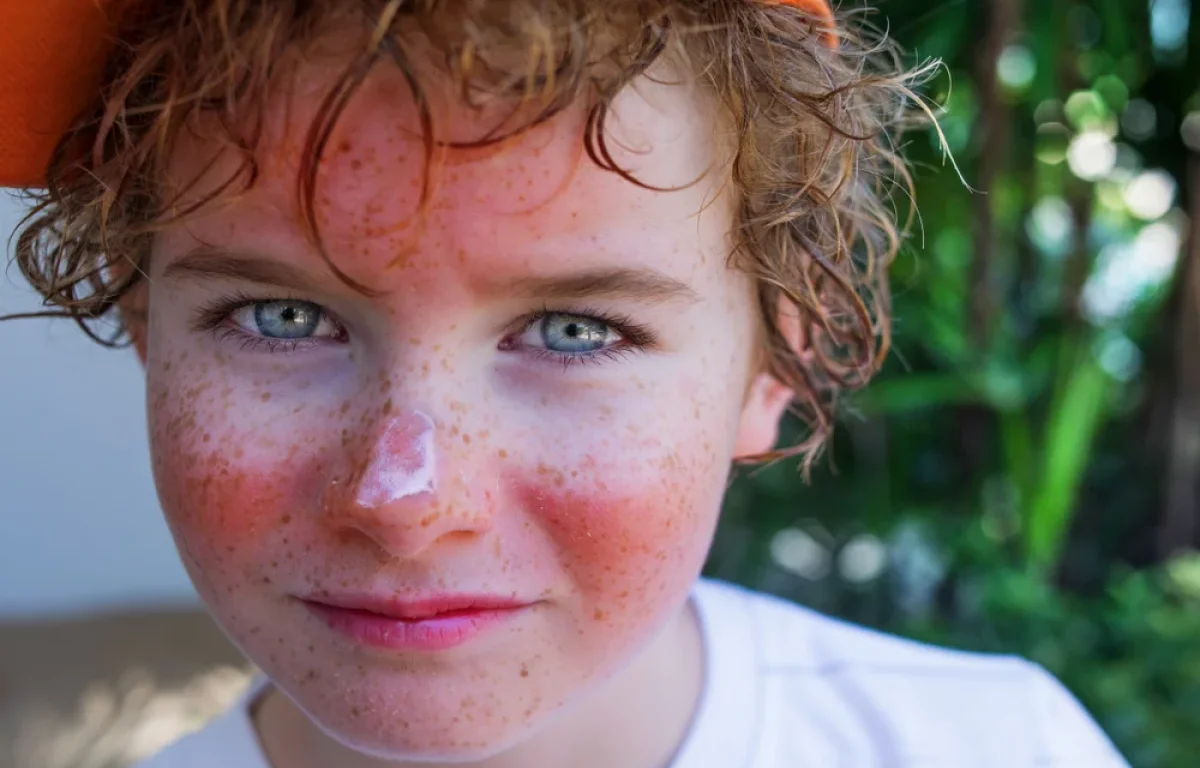 העור שלנו תחת התקפה: מה שמש עושה לו, ואיך אפשר לשמור עליו העור שלנו תחת התקפה: מה שמש עושה לו, ואיך אפשר לשמור עליו