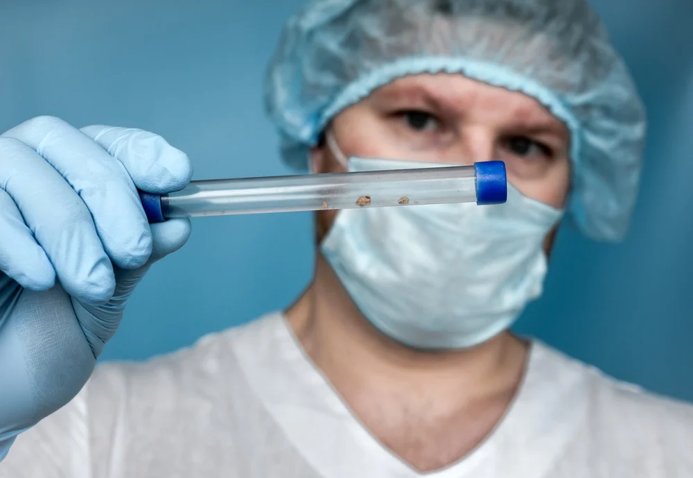 סוף סוף פתרון: כך תדעו ממה באמת נוצרה האבן בכליה סוף סוף פתרון: כך תדעו ממה באמת נוצרה האבן בכליה