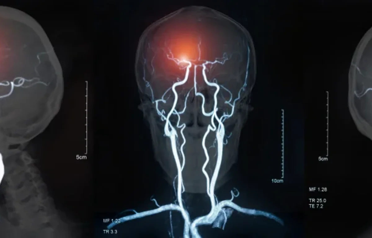 "רצף של טעויות אבחנתיות &ndash; ואירוע מוחי שניתן היה למנוע": פיצוי של יותר מ-3 מיליון ש"ח לאישה שנותרה סיעודית