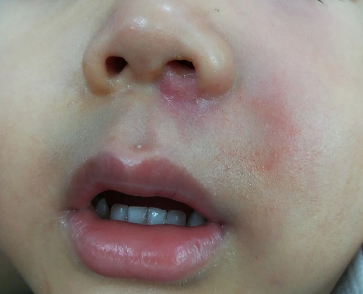 נפוץ כמו עקיצה – מדבק כמו שפעת: הזיהום הקיצי שהורים חייבים להכיר נפוץ כמו עקיצה – מדבק כמו שפעת: הזיהום הקיצי שהורים חייבים להכיר