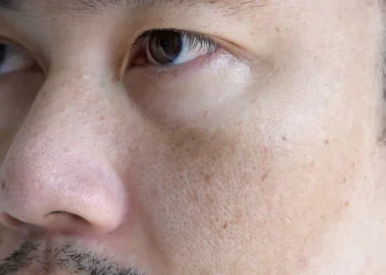 כתמי גיל? תיפרדו מהם עם מה שיש לכם במטבח