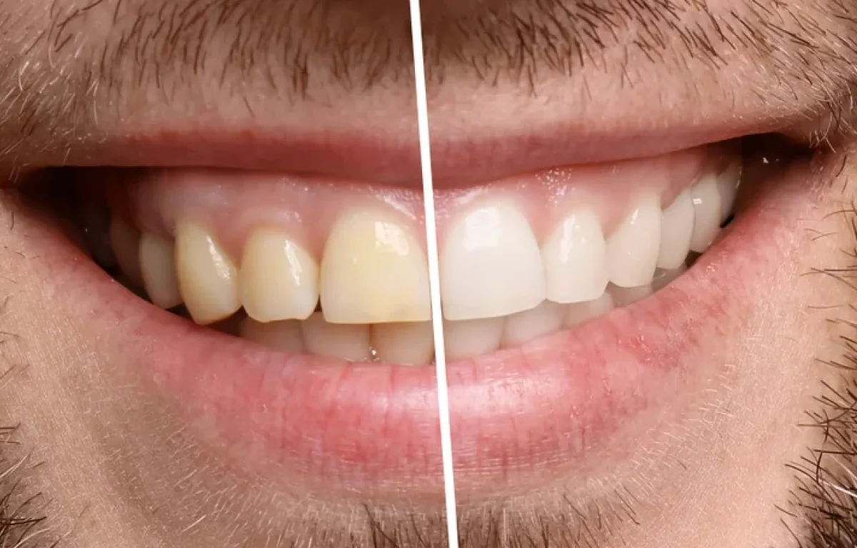 לא רק עישון: אלו מאכלים שגורמים לשיניים להצהיב