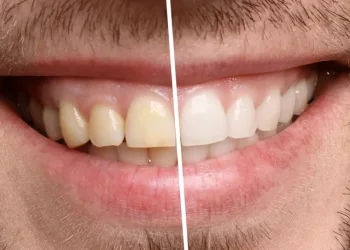 לא רק עישון: אלו מאכלים שגורמים לשיניים להצהיב