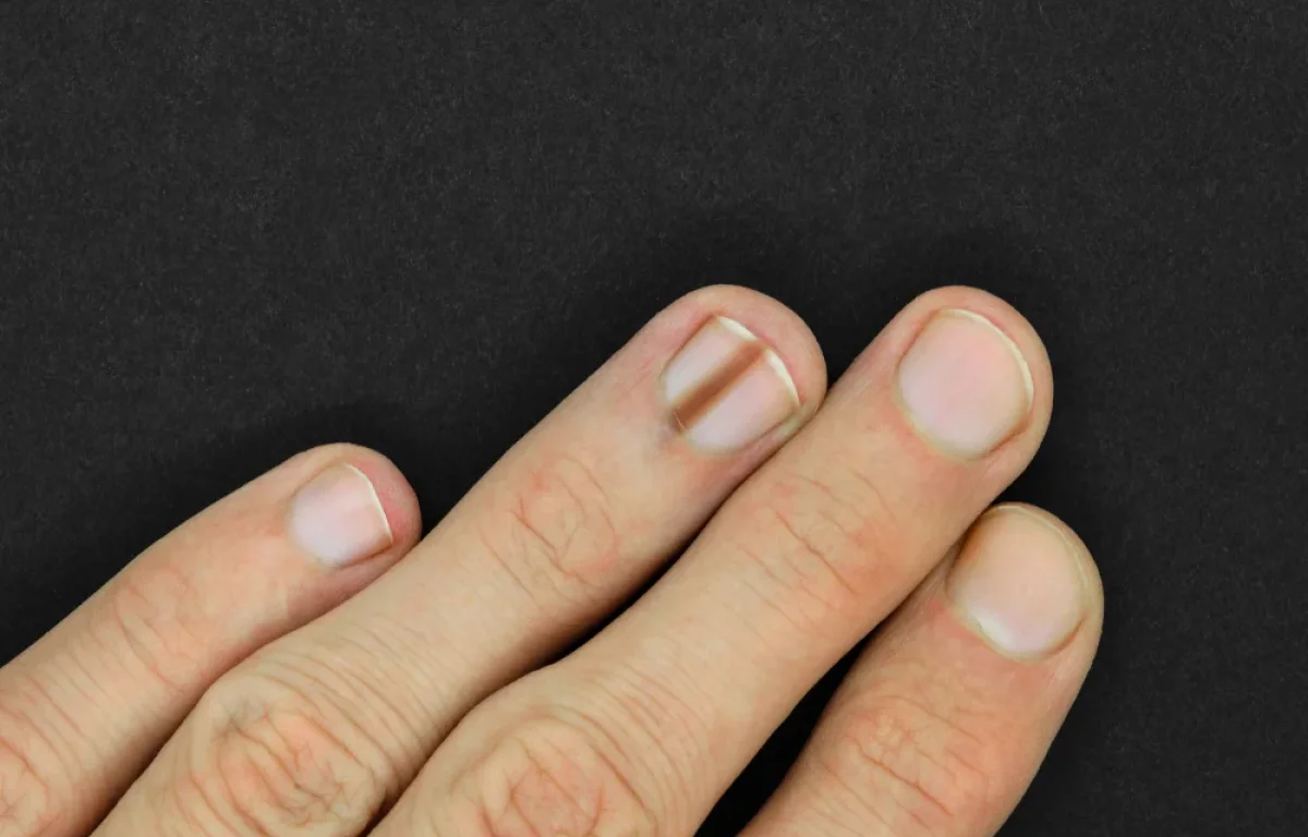 חשבת שזה סתם פגם בציפורן? הטעות שעלולה לעלות בחיים