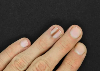 חשבת שזה סתם פגם בציפורן? הטעות שעלולה לעלות בחיים