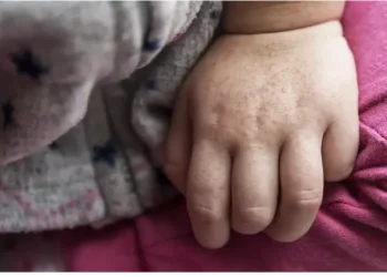 פריחה מוזרה על הילד? תירגעו – זו כנראה דווקא החדשות הטובות פריחה מוזרה על הילד? תירגעו – זו כנראה דווקא החדשות הטובות