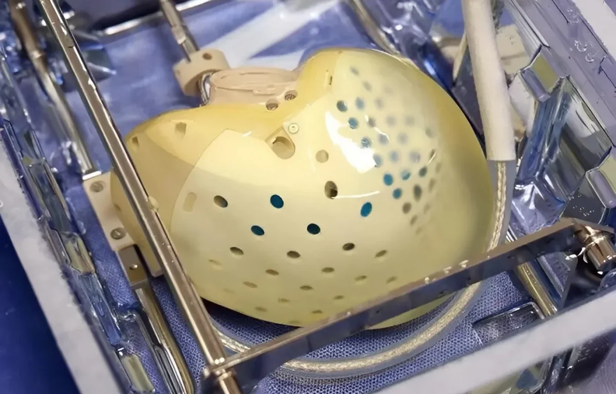 "הוצאנו את הלב &ndash; והכנסנו עתיד": ניתוח נדיר בשיבא פותח עידן חדש לחולי לב בישראל