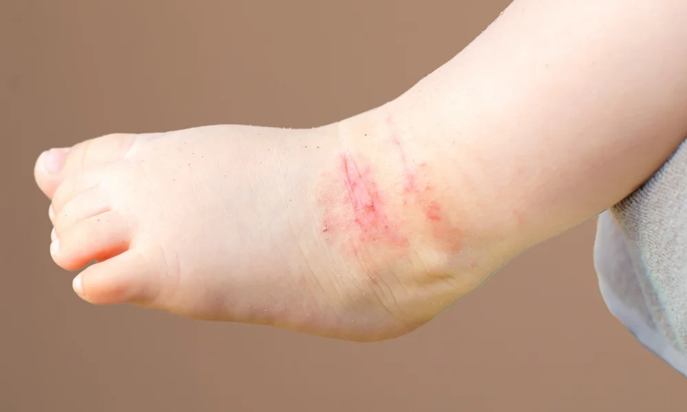 ועדת הבריאות מזהירה: עלייה מדאיגה באבחון אקזמת העור - 70 אלף חולים חדשים כמידי שנה