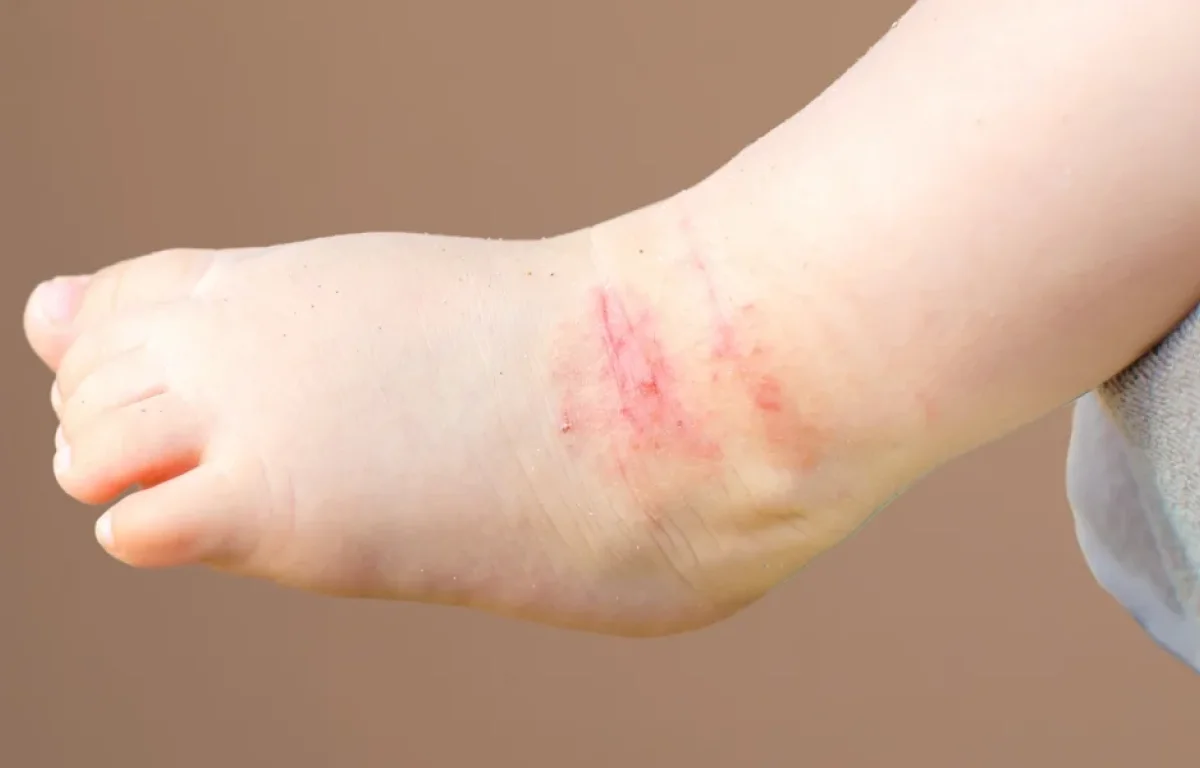 ועדת הבריאות מזהירה: עלייה מדאיגה באבחון אקזמת העור - 70 אלף חולים חדשים כמידי שנה