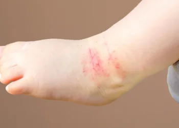 ועדת הבריאות מזהירה: עלייה מדאיגה באבחון אקזמת העור - 70 אלף חולים חדשים כמידי שנה