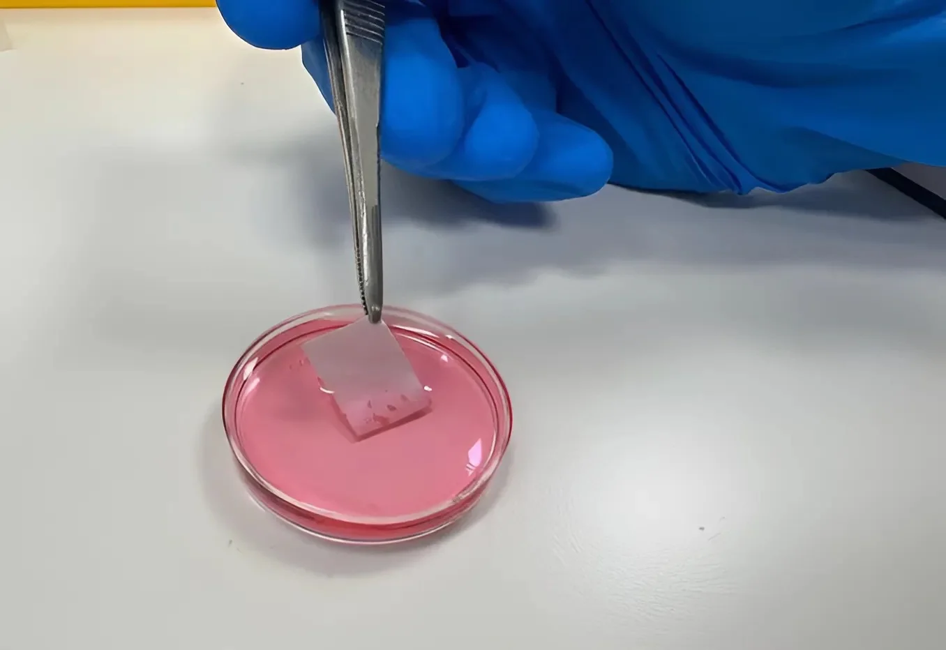 מדע החיים: מהפכה ישראלית בטיפול בכוויות – שתל עור מהונדס מתאי המטופל מדע החיים: מהפכה ישראלית בטיפול בכוויות – שתל עור מהונדס מתאי המטופל