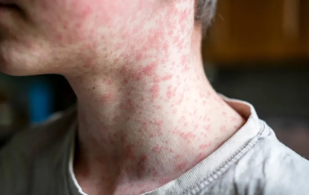 קדחת, חצבת ווריאנט חדש: סכנת נגיפים בישראל