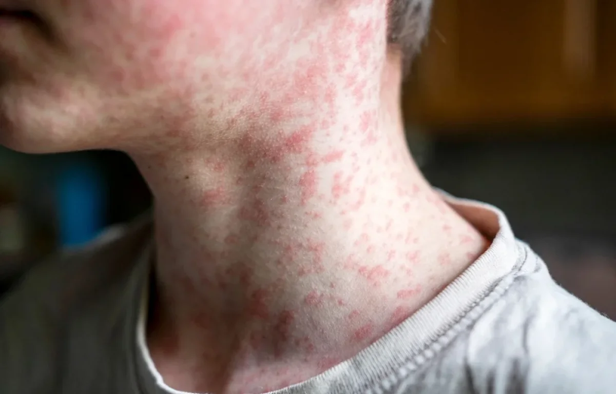 קדחת, חצבת ווריאנט חדש: סכנת נגיפים בישראל קדחת, חצבת ווריאנט חדש: סכנת נגיפים בישראל