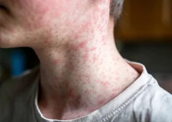 קדחת, חצבת ווריאנט חדש: סכנת נגיפים בישראל קדחת, חצבת ווריאנט חדש: סכנת נגיפים בישראל