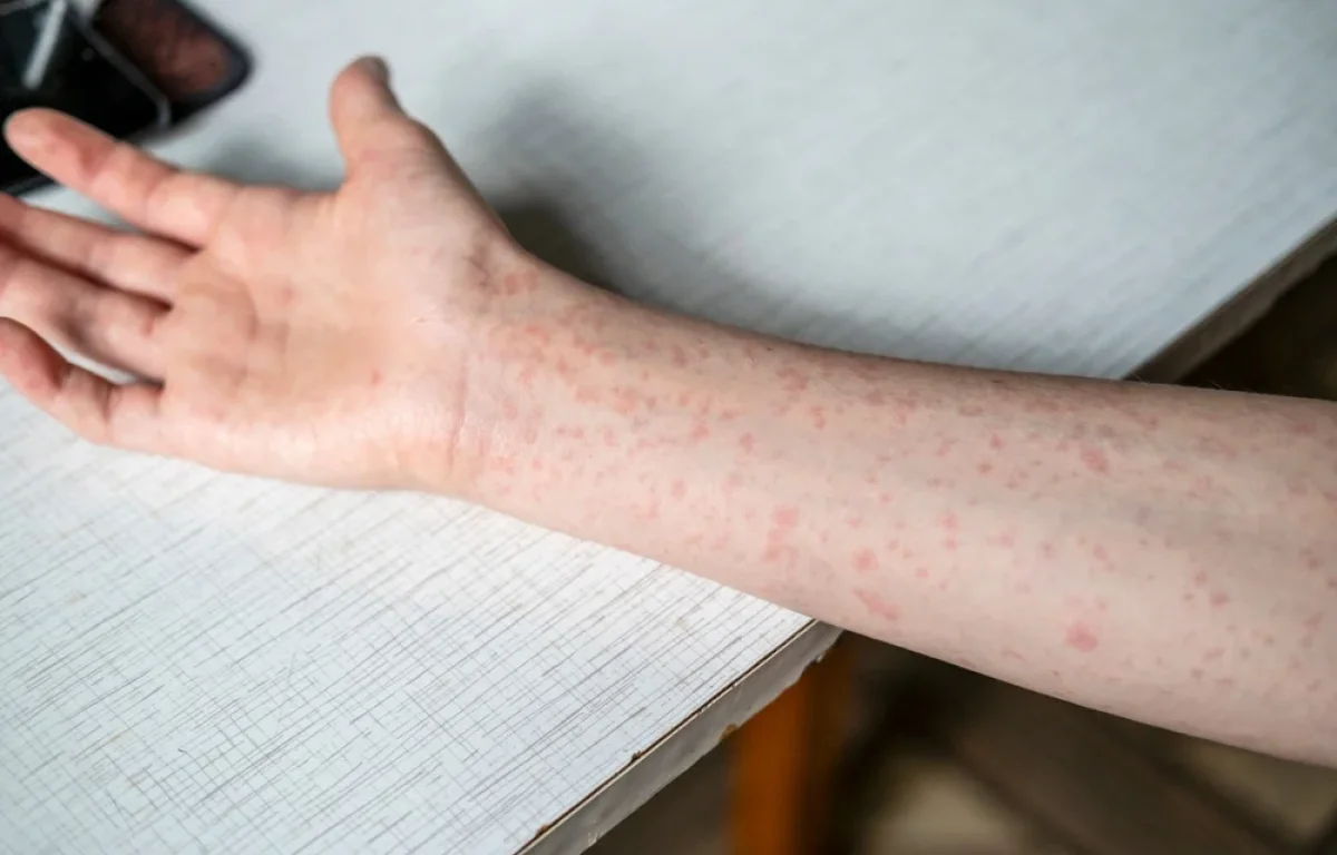 מאות חולים בעולם, עשרות בארץ: החצבת לא נעלמה