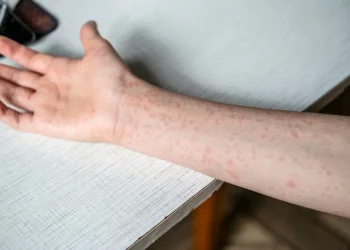 מאות חולים בעולם, עשרות בארץ: החצבת לא נעלמה