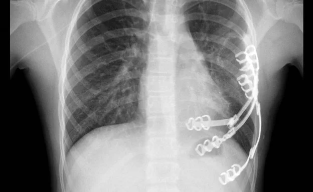 הילדה שניצחה את הגידול: ויולטה מבלארוס עברה ניתוח נדיר בשניידר, והחלימה