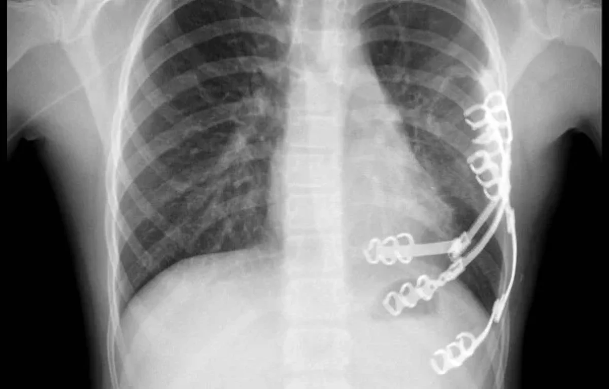 הילדה שניצחה את הגידול: ויולטה מבלארוס עברה ניתוח נדיר בשניידר, והחלימה