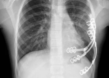 הילדה שניצחה את הגידול: ויולטה מבלארוס עברה ניתוח נדיר בשניידר, והחלימה