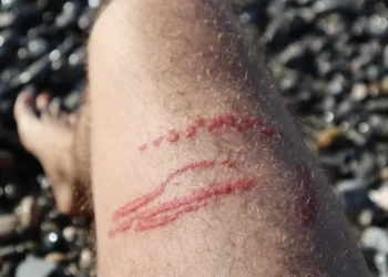 האורח הכי צורב של הקיץ חזר: וזה מה שיציל אתכם מהכאב האורח הכי צורב של הקיץ חזר: וזה מה שיציל אתכם מהכאב