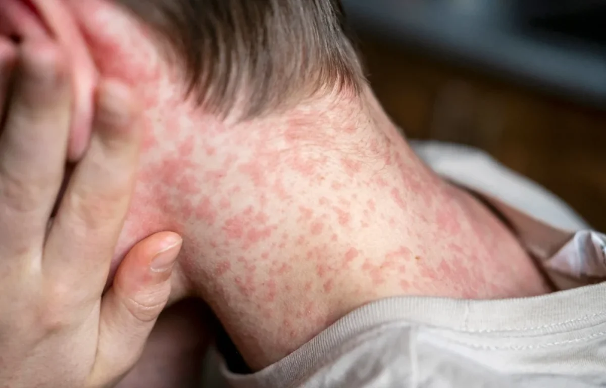 ירושלים: פעוט כבן שנה נפטר, ככל הנראה מסיבוכי חצבת 