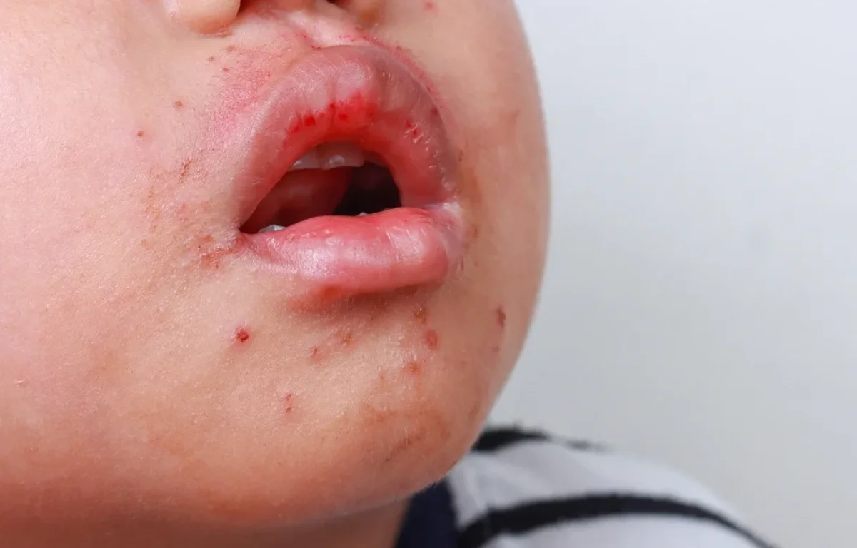 החצבת מתפשטת והפעם זה קטלני: "ילדים מגיעים עם סטורציה קריטית"