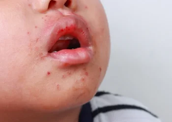 החצבת מתפשטת והפעם זה קטלני: "ילדים מגיעים עם סטורציה קריטית"