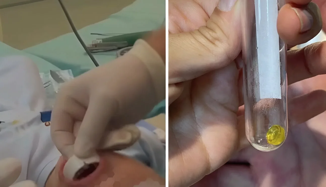 מקרה מסוכן הסתיים בנס: פעוט שאף לגו ושרד הודות לערנות האם והצוות הרפואי